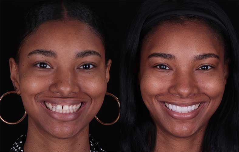 Before and after smile makeover - comprehensive dental transformation