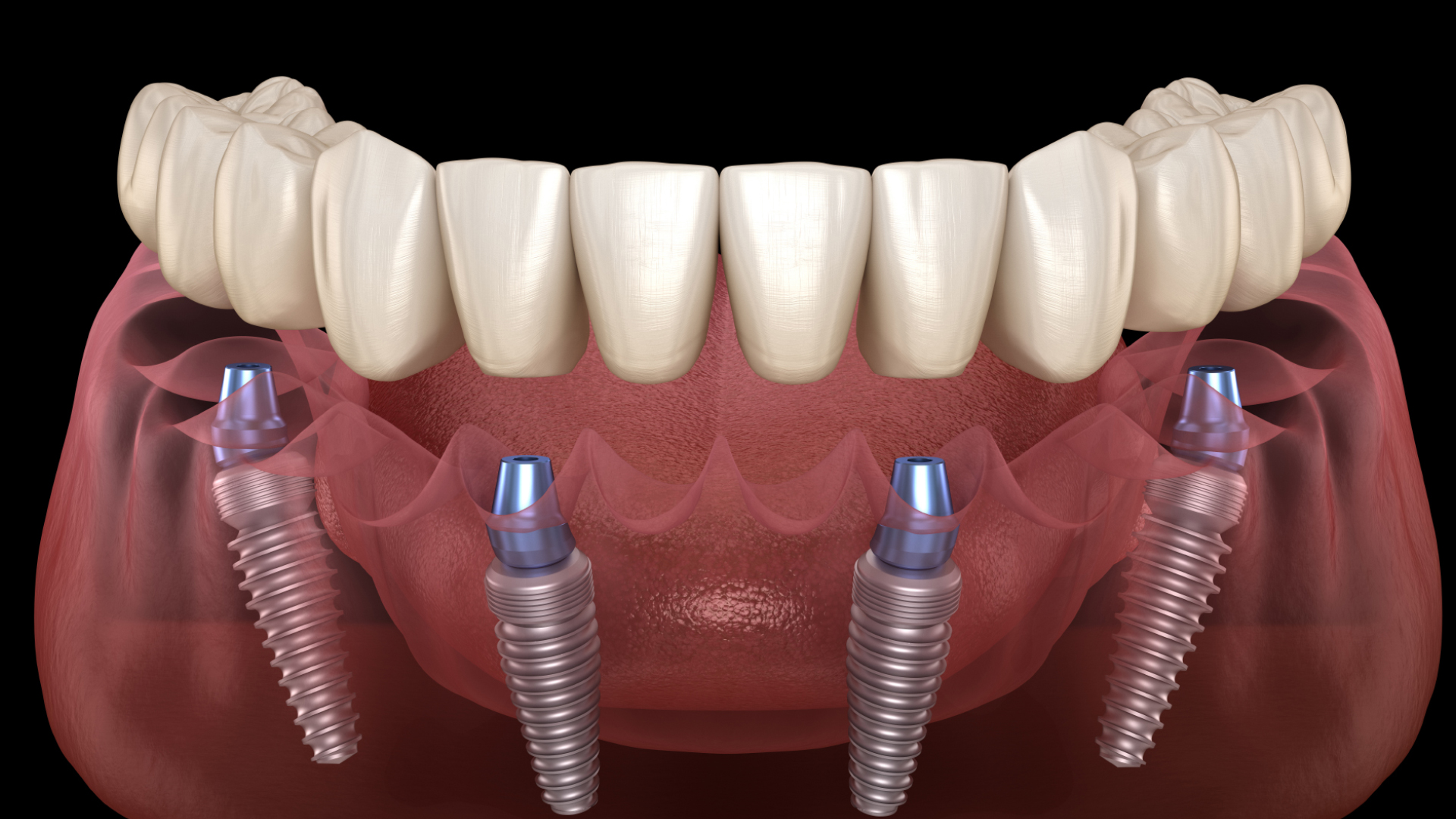 All-on-4 Implants (Single Arch)