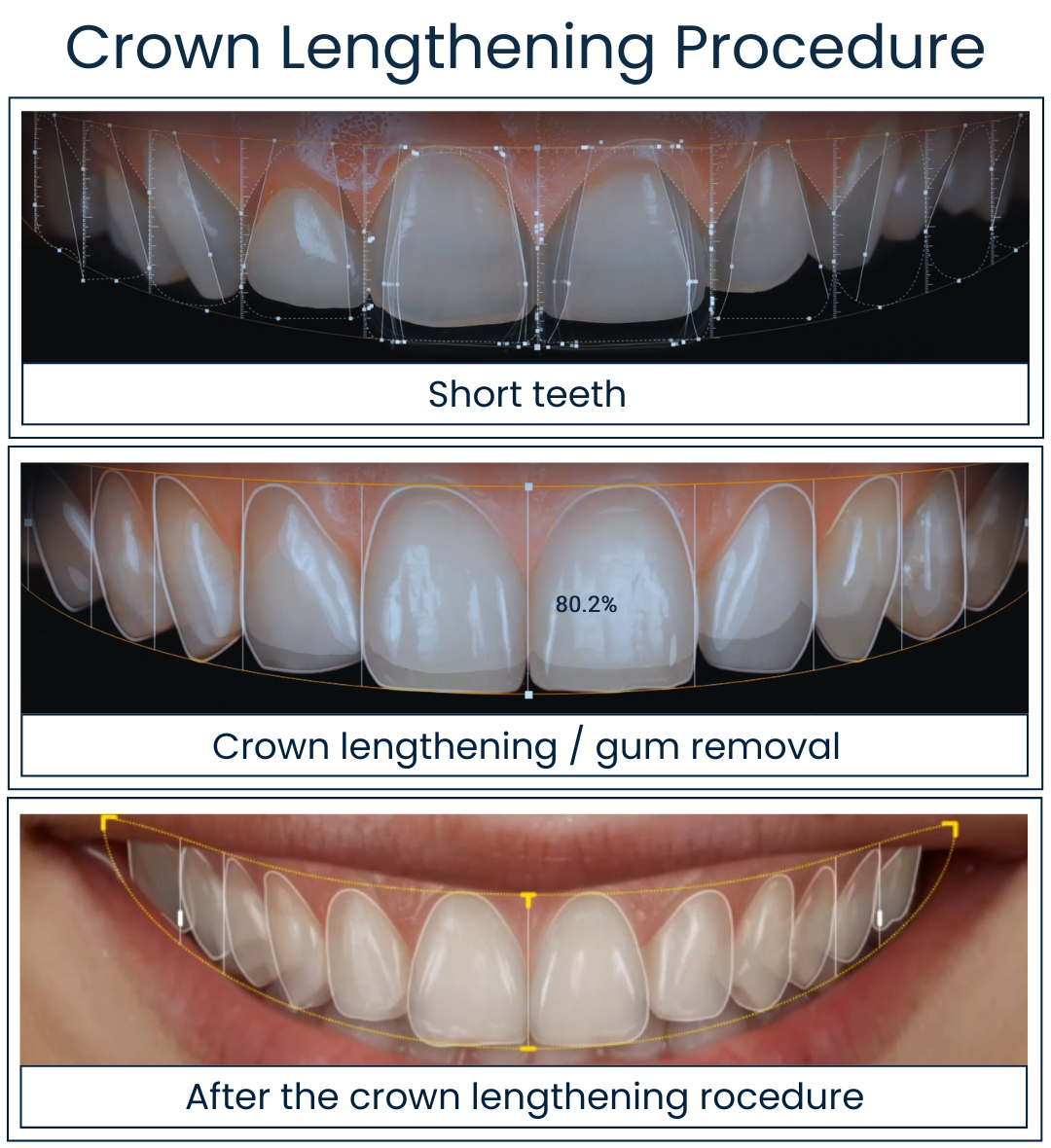 Dental Crowns: Restoration for a Stronger Smile