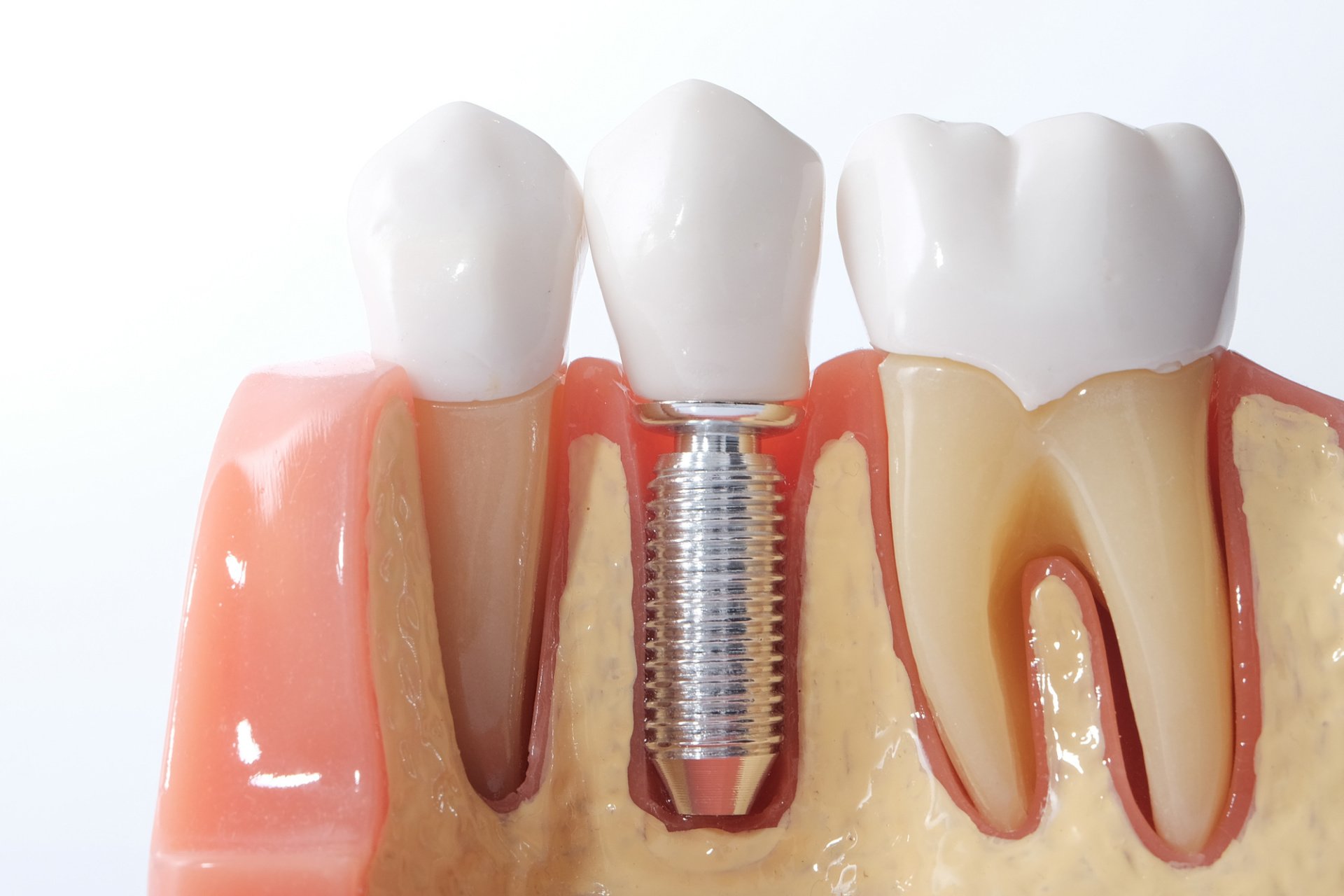 How Long Do Dental Implants Last? Maintenance and Longevity Tips