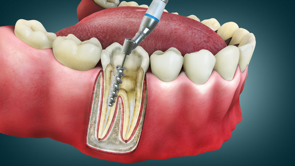 Root Canal Treatment: Myth vs. Reality