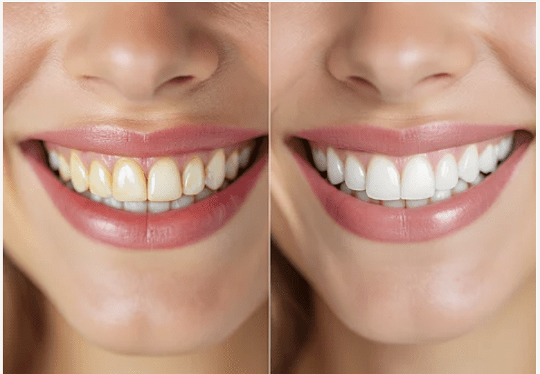Professional Teeth Whitening: Is It Worth It?