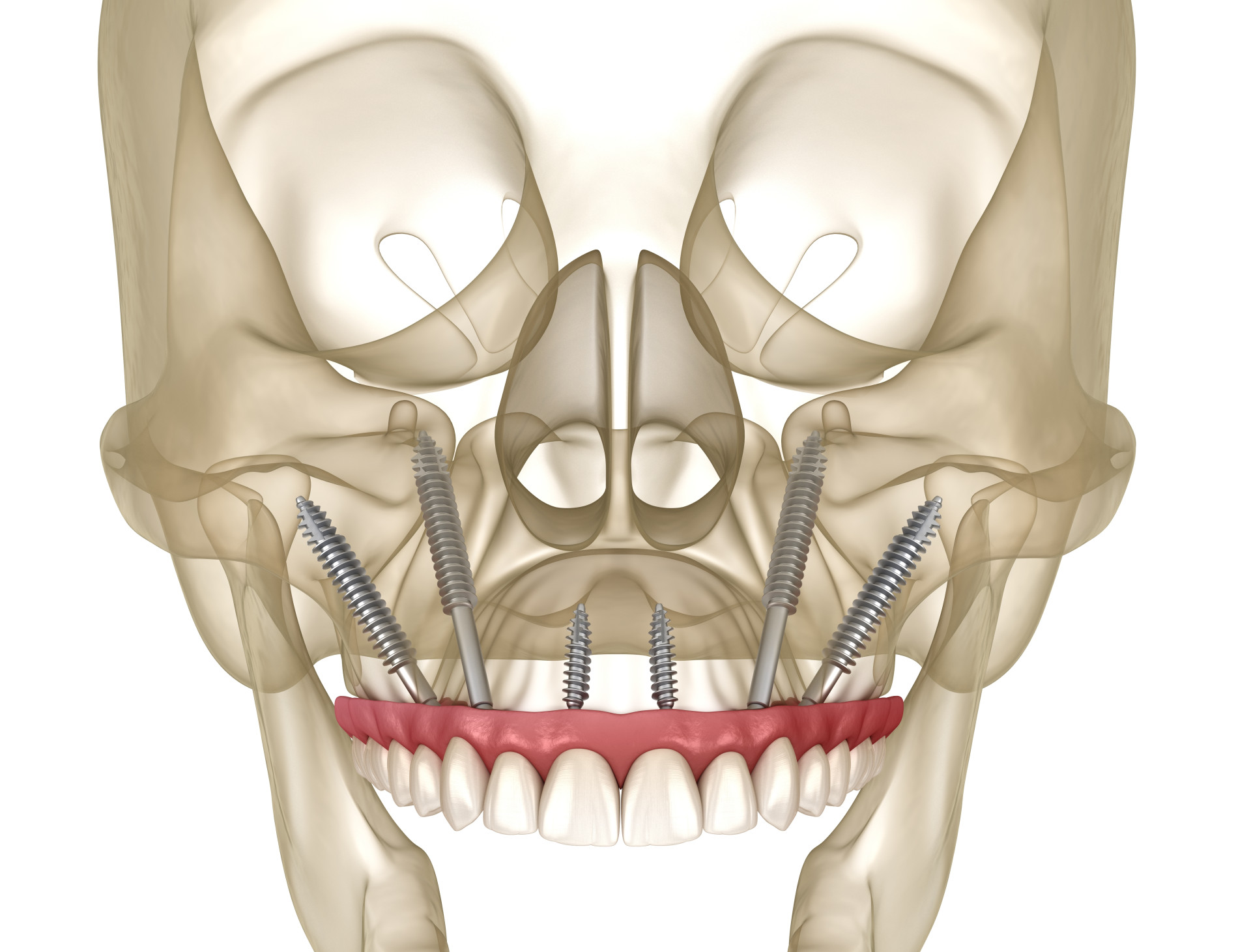 Zygomatic Implants: The Solution for Severe Bone Loss