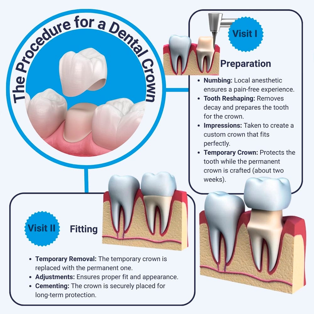 Dental crown restoration - tooth-colored crown for damaged or weakened teeth