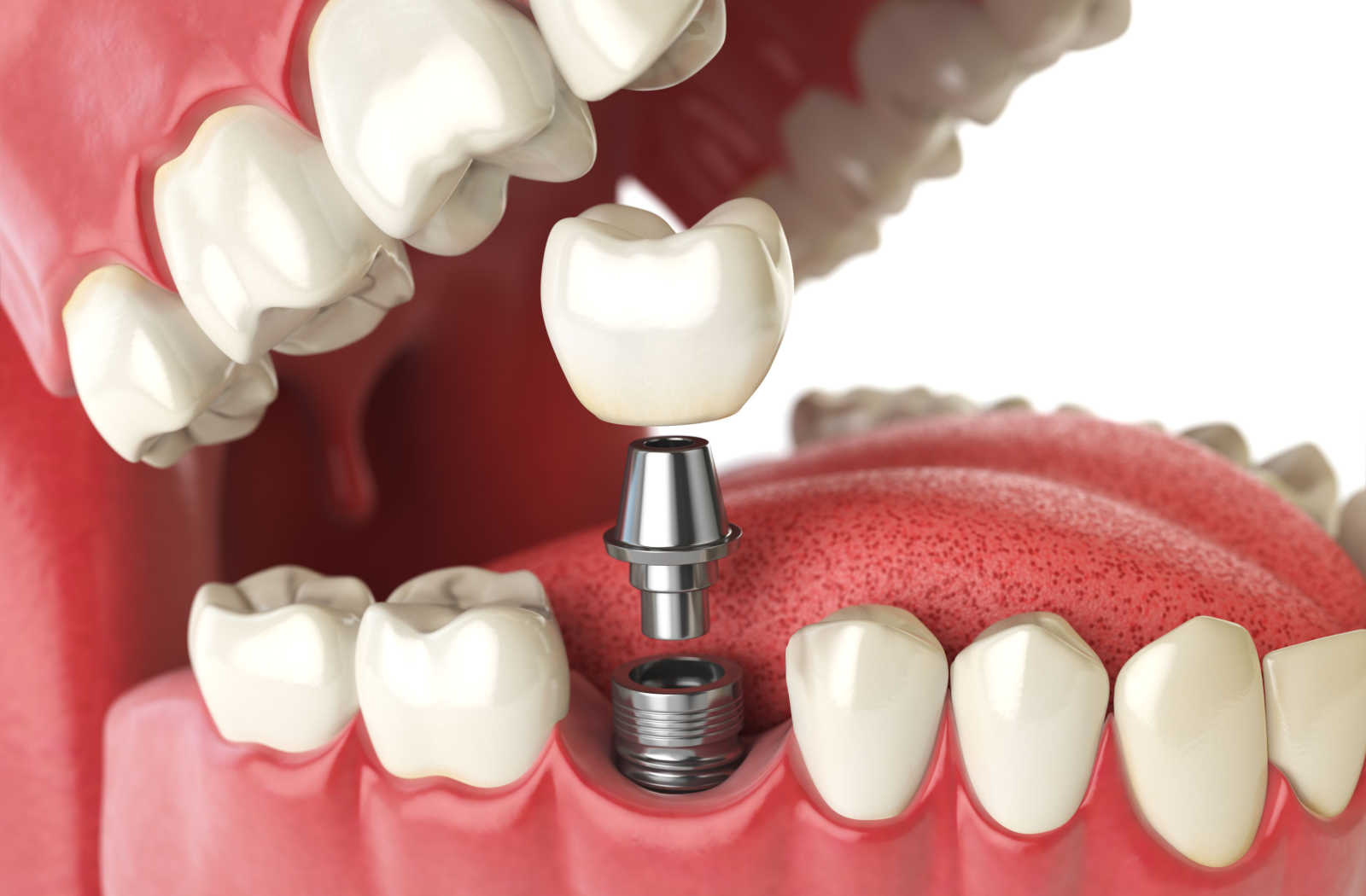 Single dental implant procedure - replacement tooth restoration for missing teeth